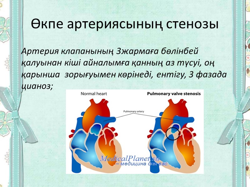 Өкпе артериясының стенозы Артерия клапанының 3жармаға бөлінбей қалуынан кіші айналымға қанның аз түсуі, оң